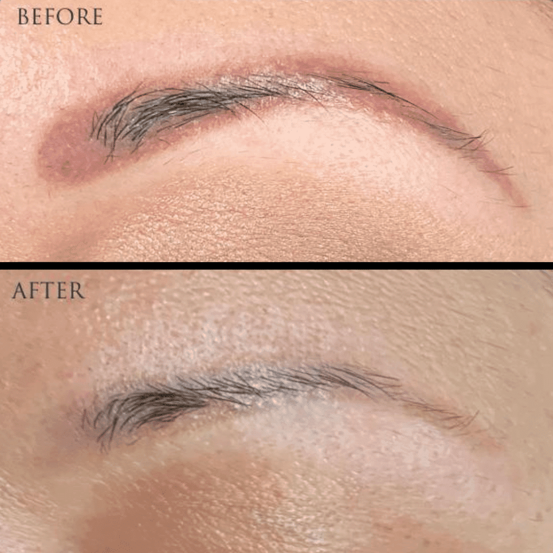 Before and after images showing eyebrow scar treatment results.
