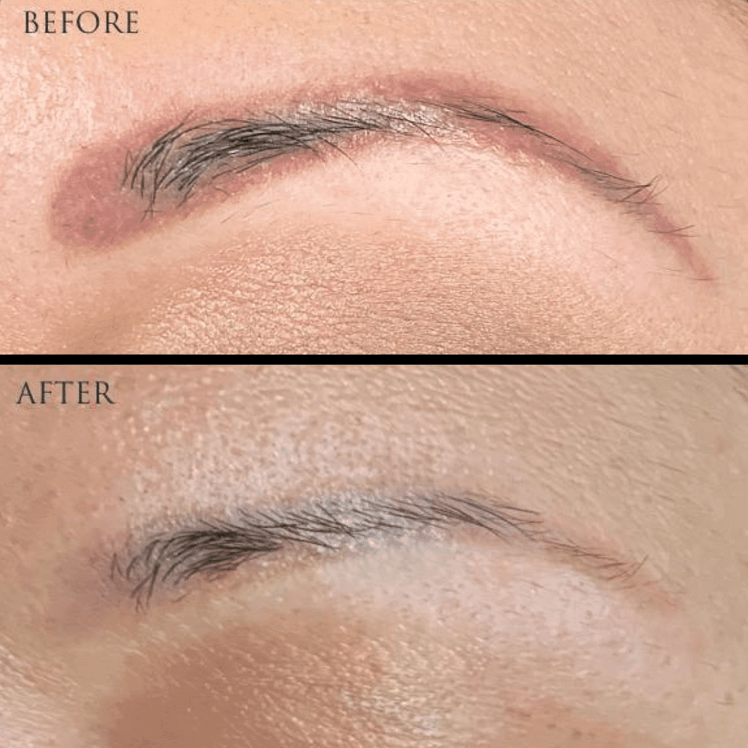 Before and after images showing eyebrow scar treatment results.
