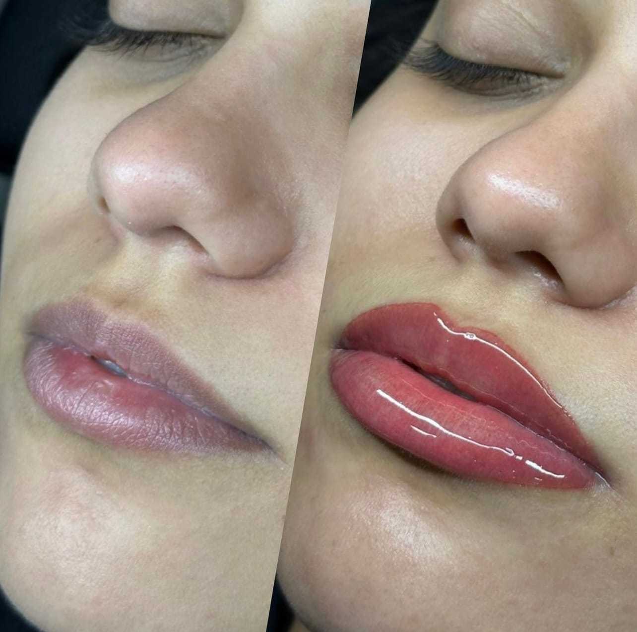 Lip enhancement transformation showcasing before and after results.