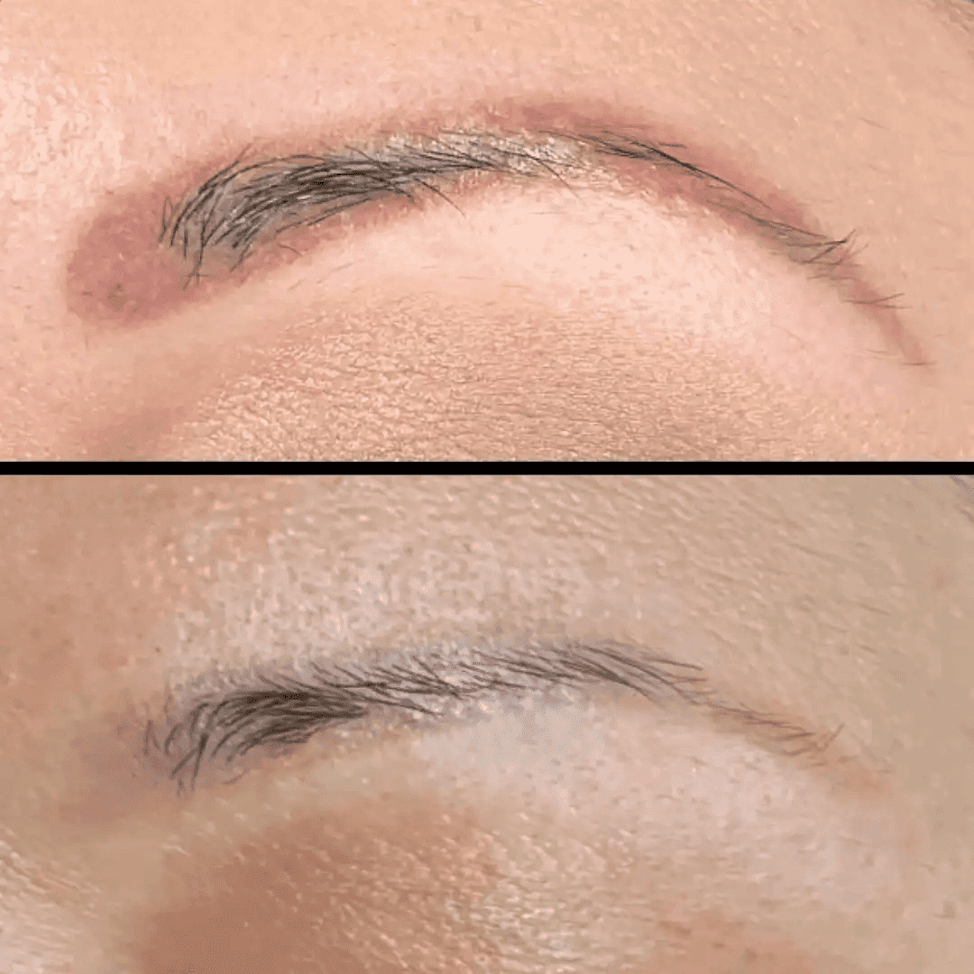 Close-up of eyebrow tattoo before and after removal treatment.